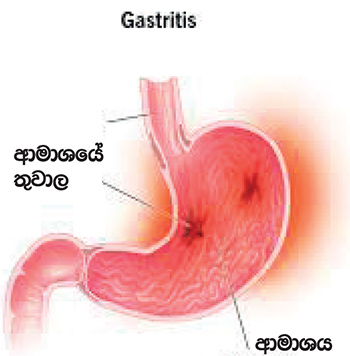 Gastritis වලට චීන කටු ප්‍රතිකාර